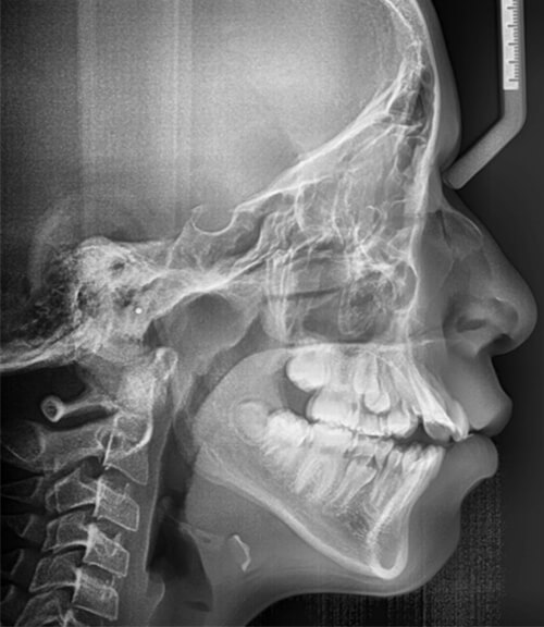 Fig.5 Radiografía lateral de cráneo inicio