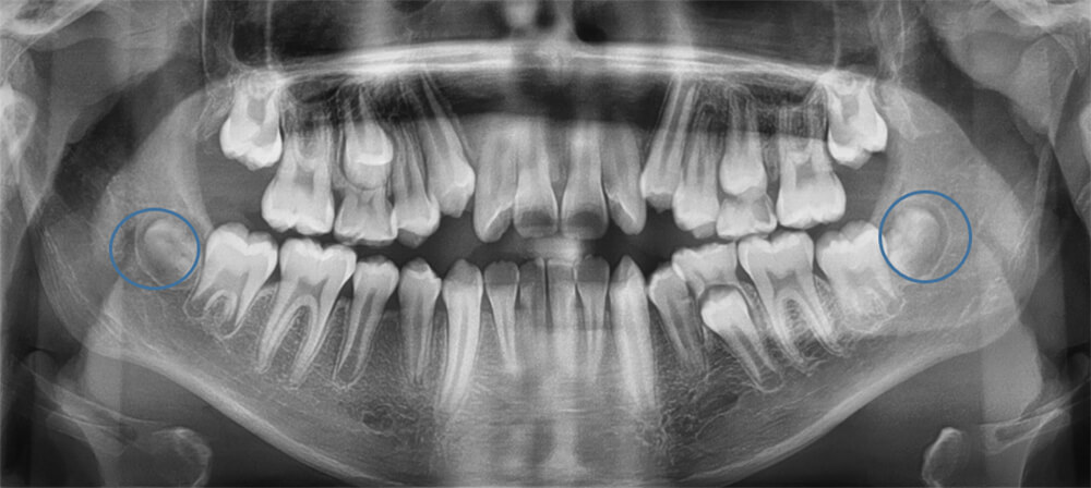 Fig.6 Radiografía panorámica inicio