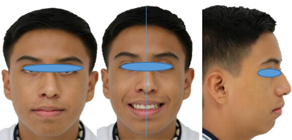 Fig.7 Extraoral final frente, reposo sonrisa perfil