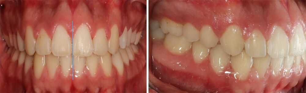 Fig.8 Intraoral frente, lateral derecha final