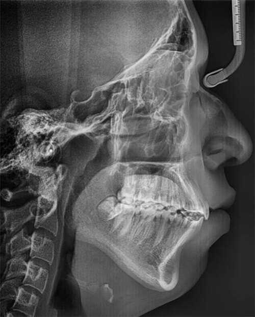 Fig.9 Radiografía lateral de cráneo final