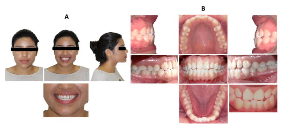 Figura 1. Fotografías iniciales. A Faciales de frente, sonrisa y perfil. B Intraorales.