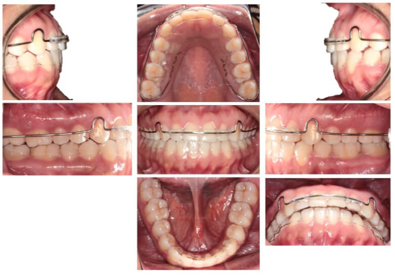 Figura 10. Radiografías finales. A Panorámica con buen paralelismo radicular y sin terceras molares. B Lateral de cráneo. C Sobreimposición.