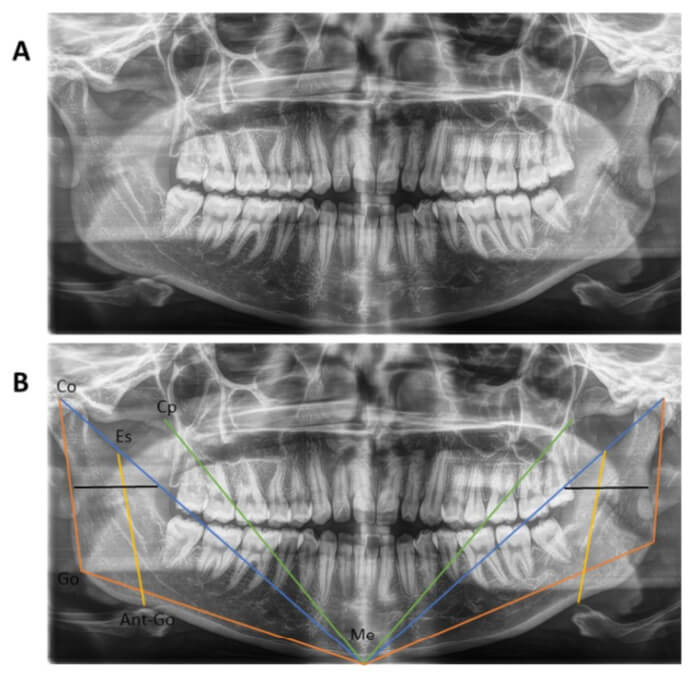 Figura 3. A Radiografía panorámica inicial. B) Trazado de Thilander.