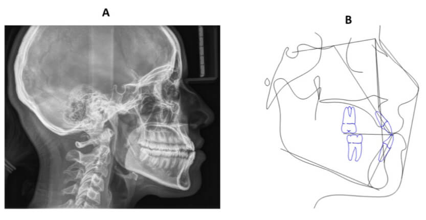 Figura 4. A Lateral de cráneo. B Trazado cefalométrico de Steiner.