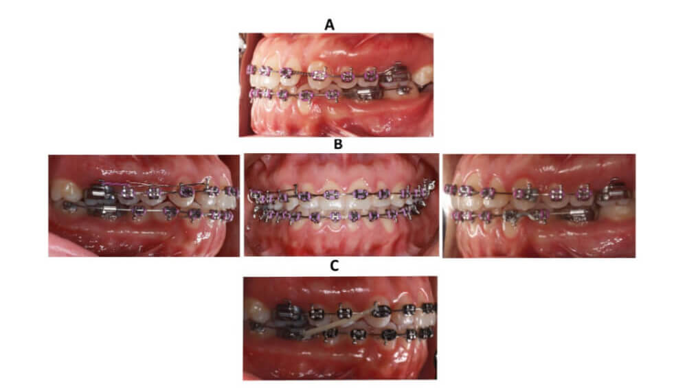 Figura 6. Fotografías de seguimiento. A Uso de resortes abiertos en laterales superiores con microdoncia, B Barril de rotación en el O.D. 23 y C Elásticos intermaxilares clase III.