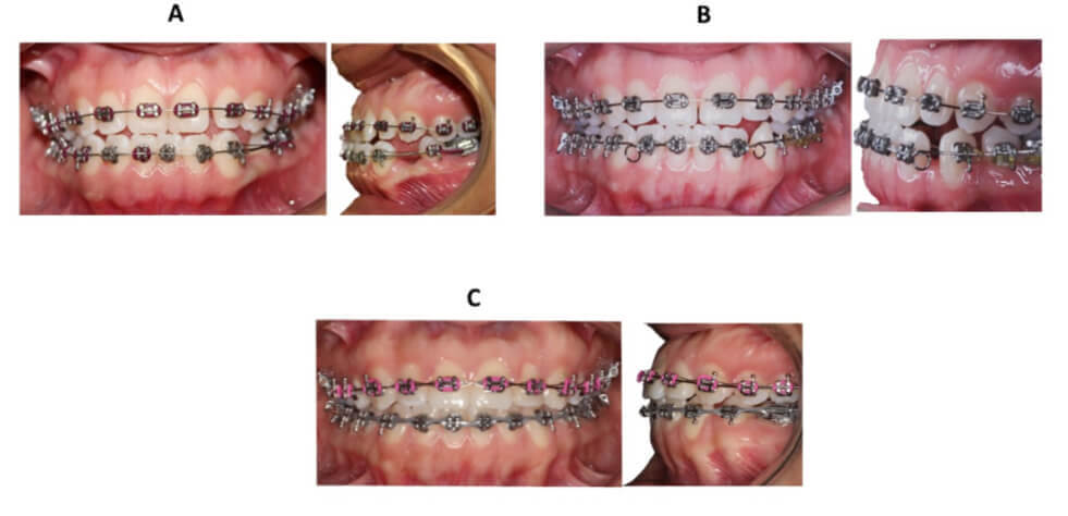 Figura 5. Fotografías de seguimiento. A Laceback al od. 33, B Arco de cierre con loop y C Cadena elástica inferior.