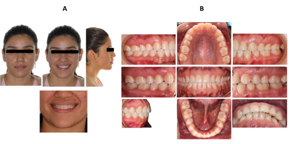 Figura 8. Fotografías finales. A Faciales de frente, sonrisa y perfil. B Intraorales.