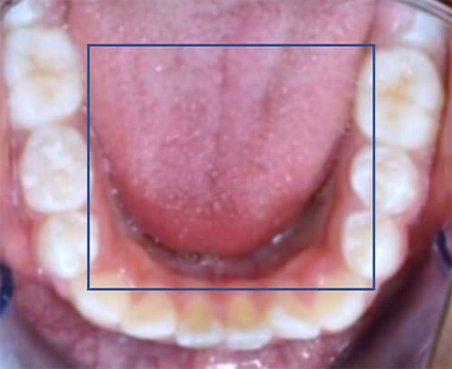 Fig. 12 Oclusal inferior