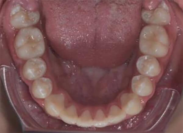 Fig. 14 Vista oclusal final