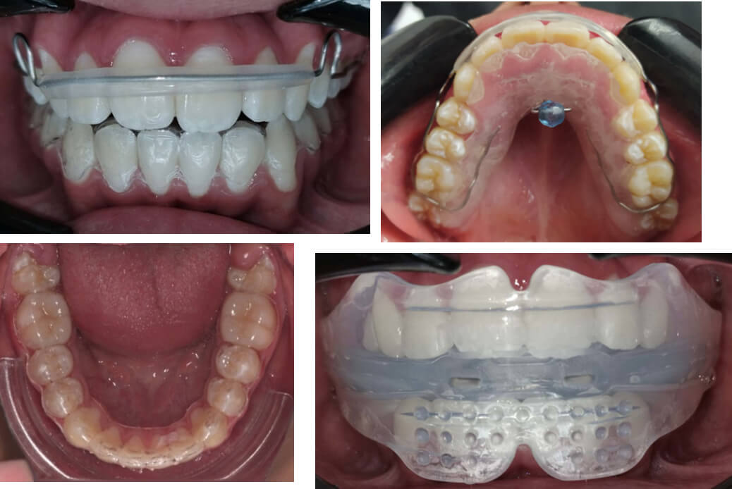 Fig. 15 Retenedores