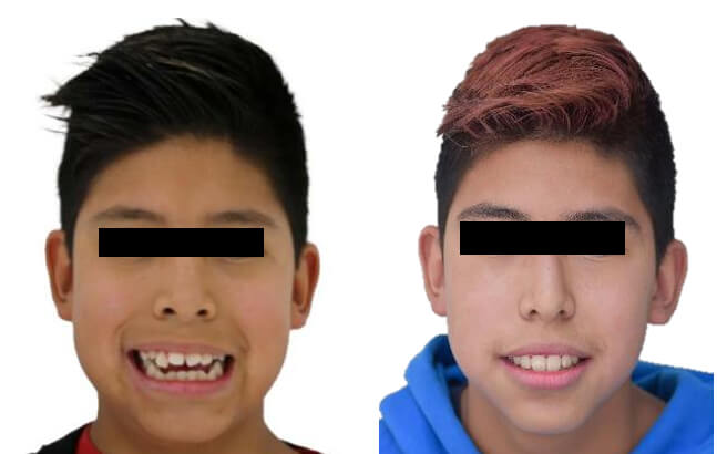 Fig. 16 Sonrisa inicio-final