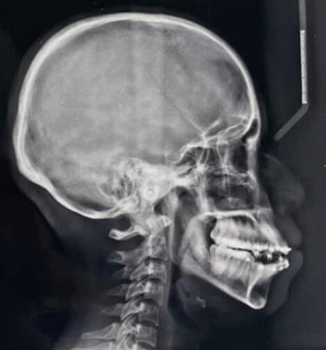 Fig. 4 Lateral de cráneo