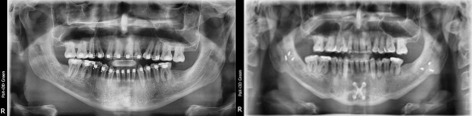 Fig. 11. Comparación Rx Panorámica inicio final