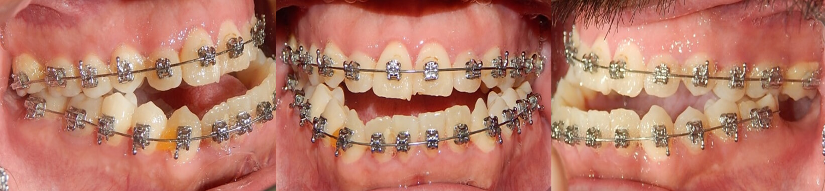 Fig. 2  Boca paciente frente, izquierda con los braquetes del tratamiento inconcluso