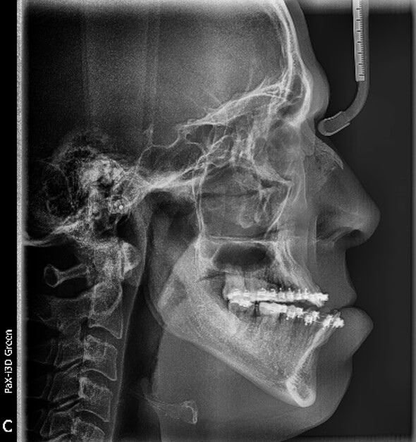 Fig. 4 Radiografía lateral de cráneo de inicio