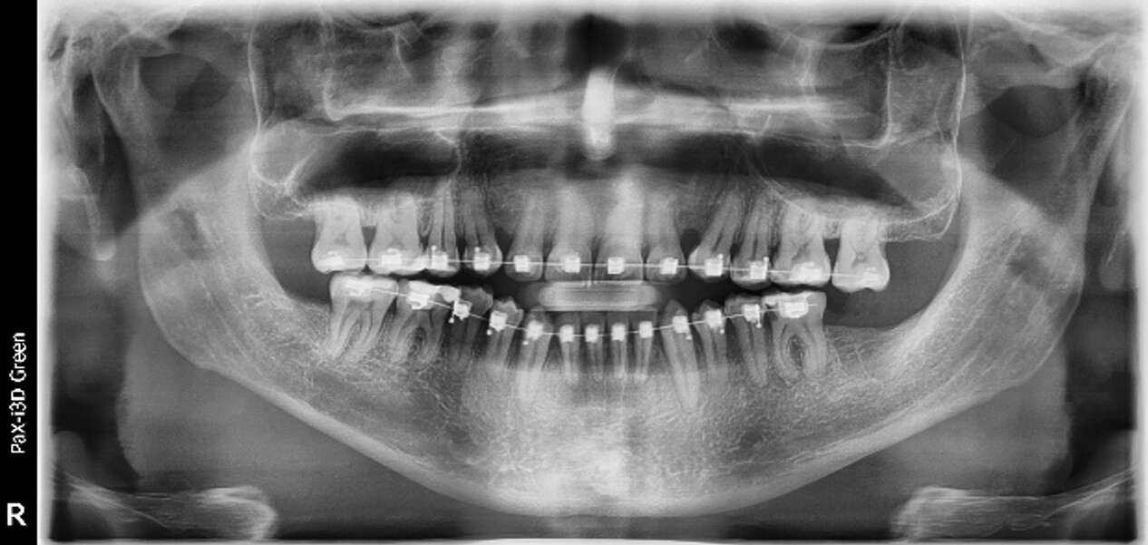 Fig. 5 Radiografía panorámica de cráneo de inicio