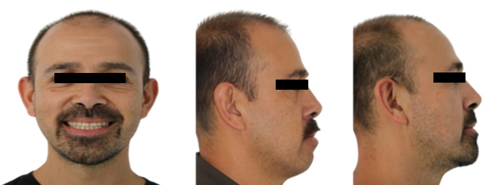 Fig. 7   frente sonrisa, perfil  inicio y final