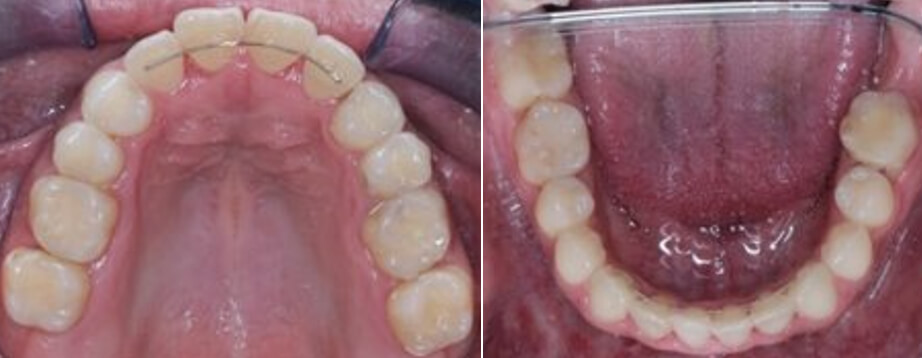  Fig. 8 oclusales superior e inferior finales