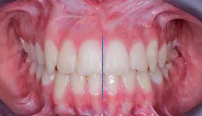 Fig.10 Intraoral frente final