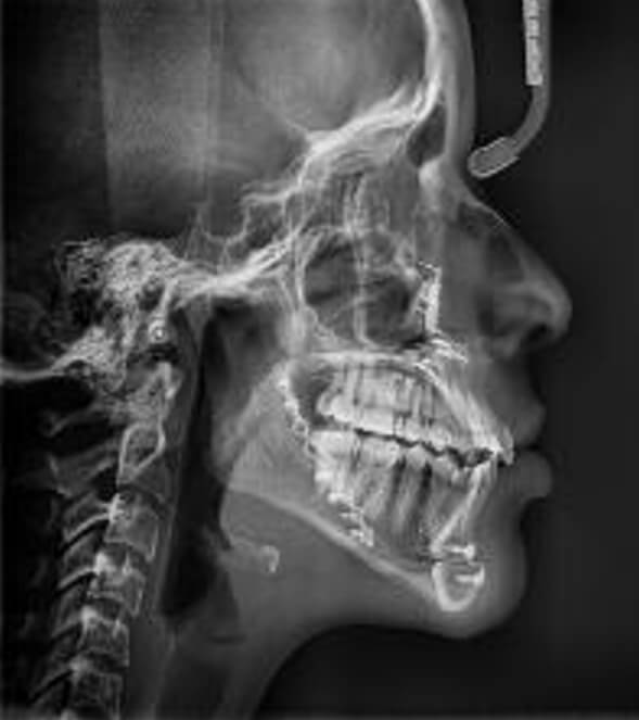 Fig.13 Radiografía lateral de cráneo