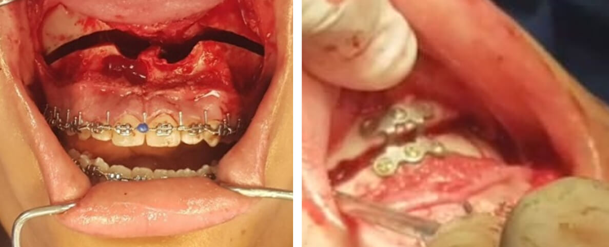 Fig.14 Cirugía Lefort 1, mentoplastia