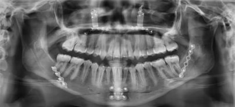 Fig.15  Radiografía panorámica final