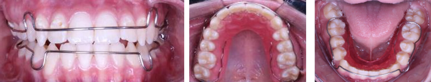 Fig.16 Intraoral de frente con retenedores y vista oclusal