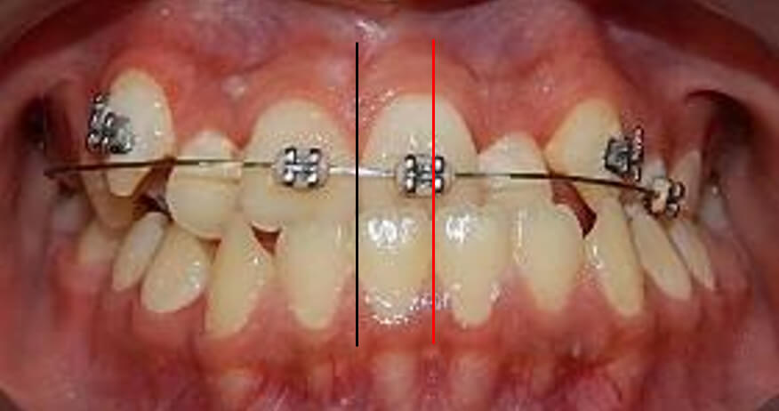 Fig.2 Intraoral de frente inicio