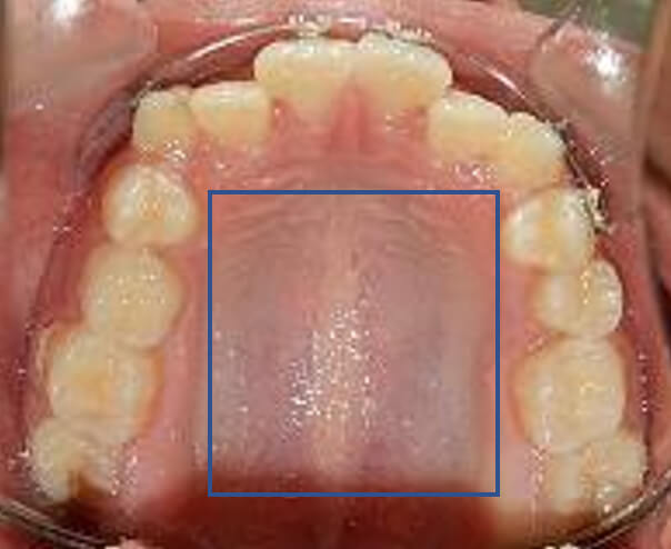 Fig.3 Intraoral oclusal superior