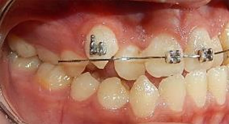 Fig.4 Intraoral lateral derecho inicio