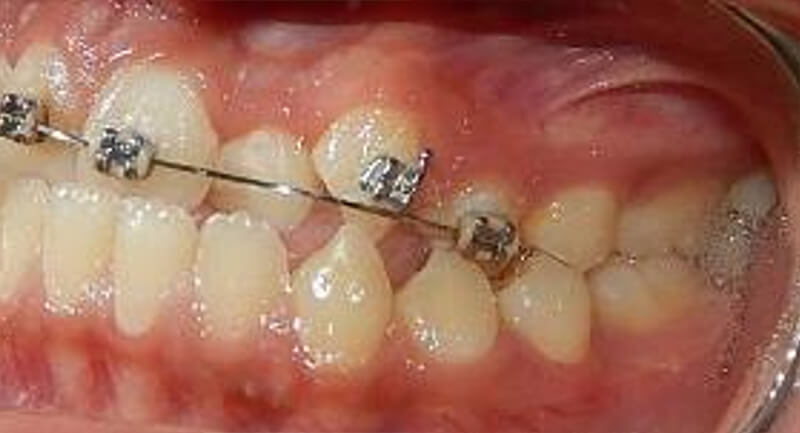 Fig.5 Intraoral lateral izquierda inicio