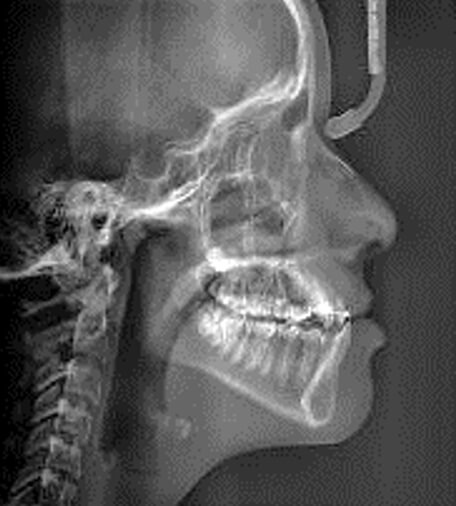 Fig.6 Radiografía lateral de cráneo inicio