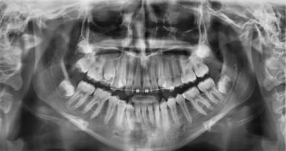 Fig.7 Radiografía panorámica inicio