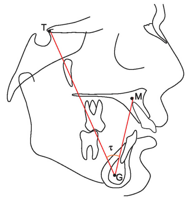 Figura 4 Triángulo Tau (Gupta, Prateek et al. 2020)