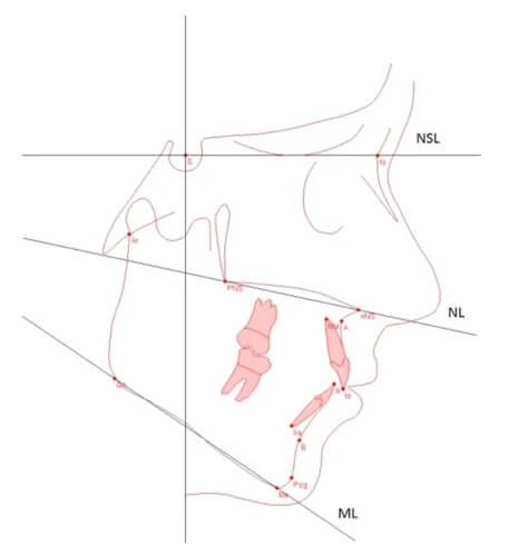 Figura 6 Planos NSL, NL y ML utilizados en las normas flotantes (Schilbred Eriksen E et al. 2017) (33)