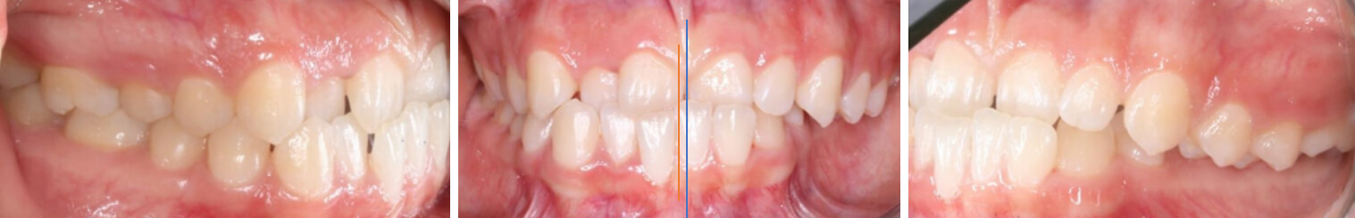 Fig. 2 intraorales inicio en oclusión, lateral derecha, frente y lateral izquierda