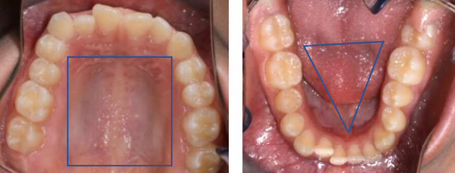 Fig. 3 oclusal superior e inferior