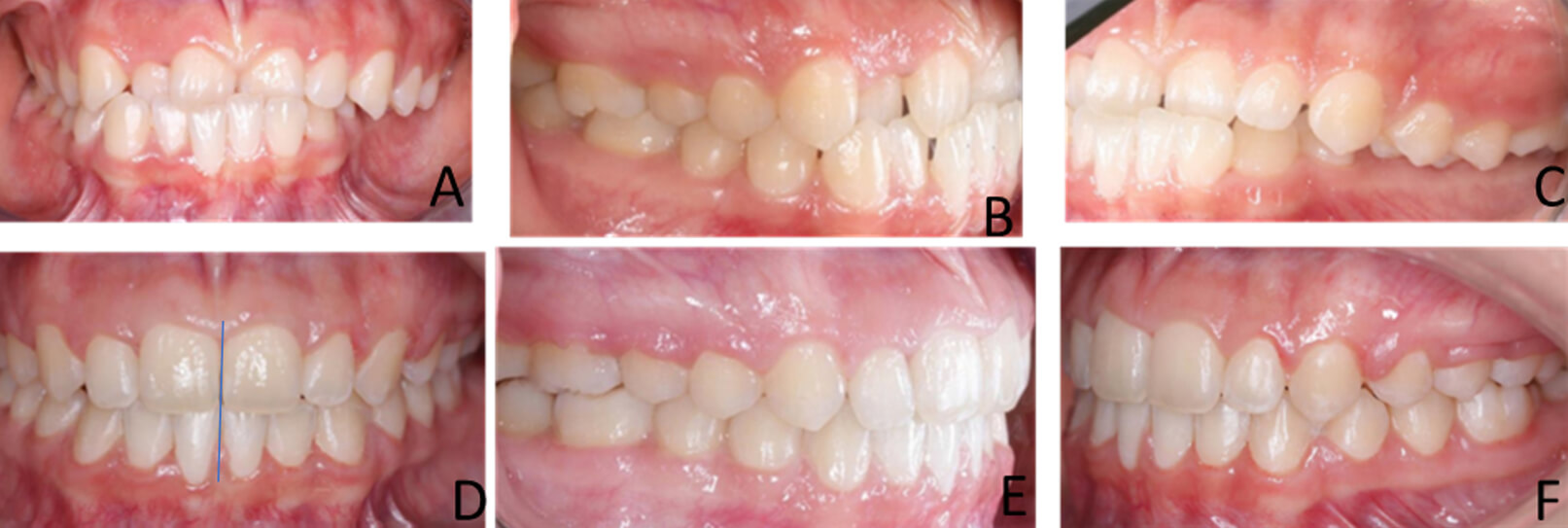 Fig. 5 comparación de las intraorales A frente inicio, B lateral derecha, C izquierda. D frente final, E lateral derecha, F lateral izquierda final.