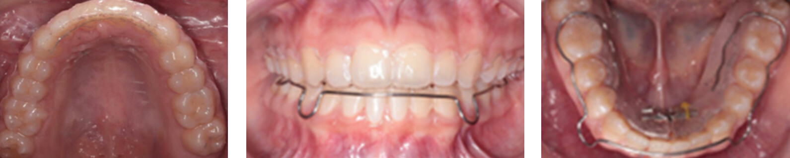 Fig. 6 retenedores termoformado en superior y circunferencial con tornillo en inferior.