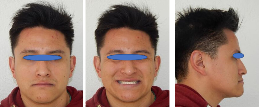 Fig. 1. Frente - Fig. 2. Sonrisa - Fig. 3. Perfil