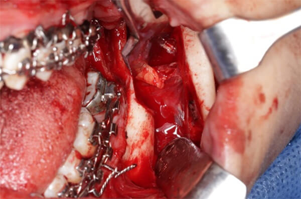 Fig. 12 Osteotomía sagital bilateral de rama