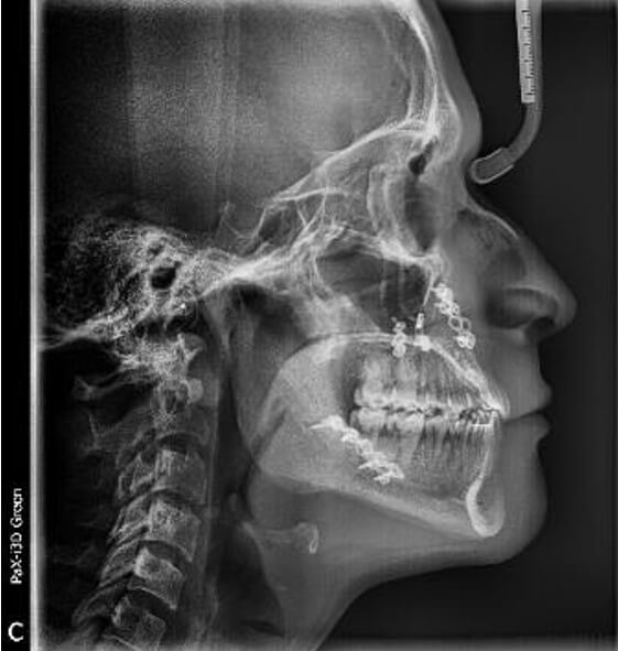 Fig. 15 Lateral de cráneo