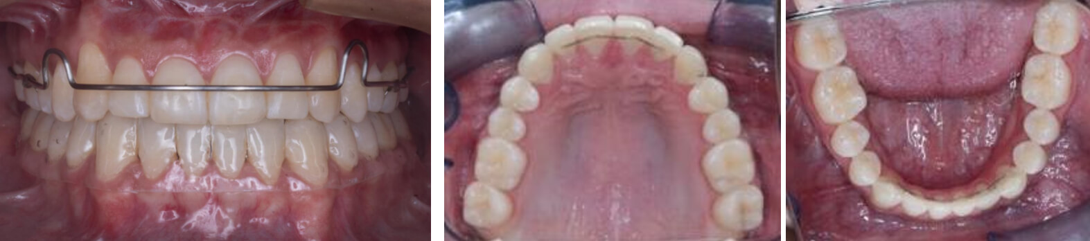 Fig. 17 Circunferencial superior, fijo superior inferior de dos a dos, termoformado inferior.