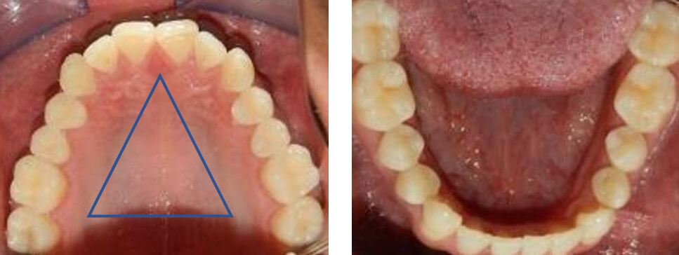 Vista oclusal superior e inferior