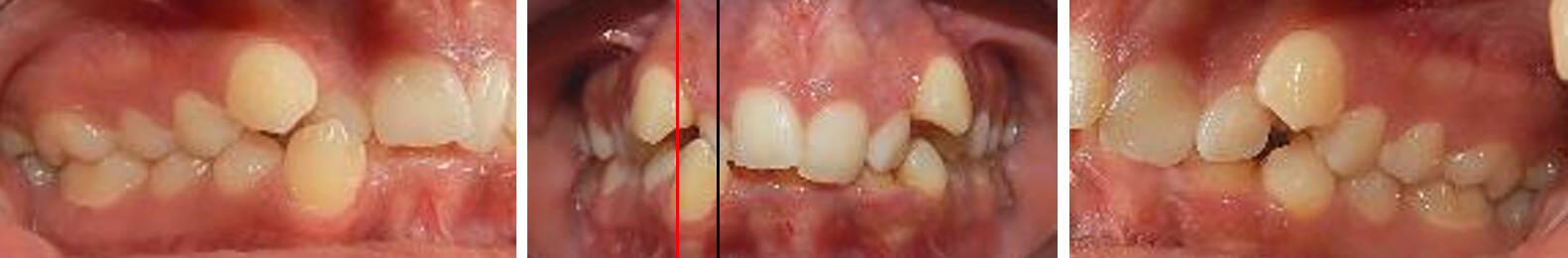 Fig. 4 Intraorales de frente, lateral derecha e izquierda