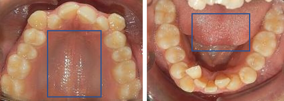 Fig. 5 Intraoral oclusal superior e inferior