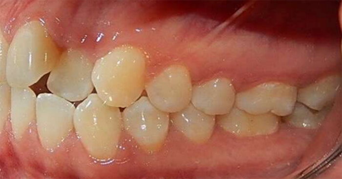 Fig. 1 Intraoral izquierda