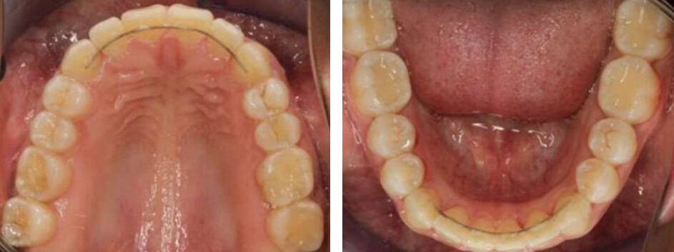 Fig. 10 Vista oclusal superior e inferior