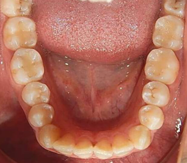 Fig. 4 Intraoral derecha